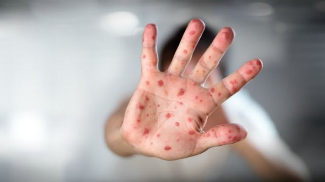 A múlt év utolsó hónapjában 1003 kanyarós megbetegedést jelentettek; egy haláleset is volt