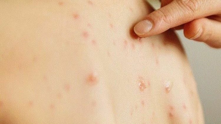 Januárban 918 kanyarós megbetegedést jelentettek