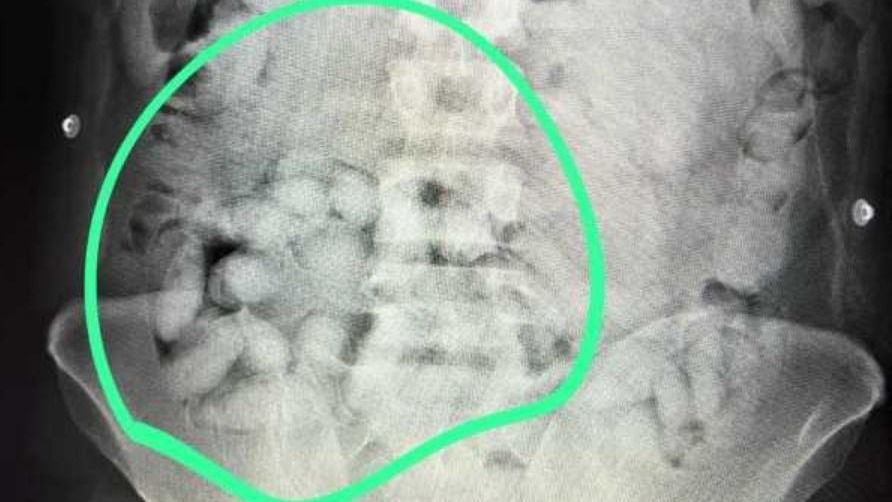 Fél kilogramm kokaint próbált becsempészni Romániába egy brazil állampolgár